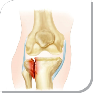 Knee Osteoarthritis