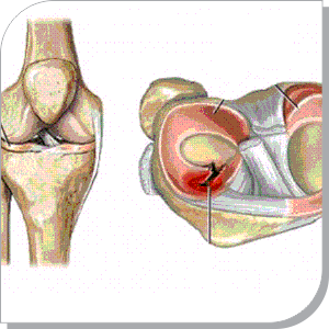 Ligament and Meniscal Tears
