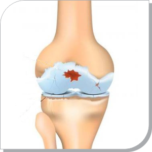 Patellofemoral Pain Syndrome