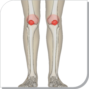 Tibia/Femur/Patellar Fractures