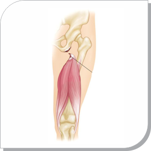 Muscle and Ligament tears