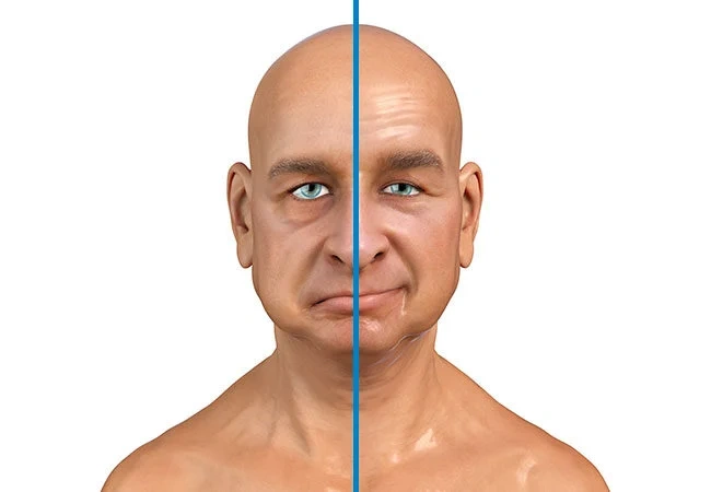 Symptoms of Bells palsy and its treatment in Pune 1 Bells palsy and its treatment Symptoms of Bells palsy and its treatment in Pune