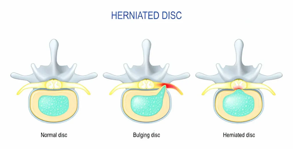 What’s Triggering Your Back Pain? Key Explanations and Solutions 2 GetPaidStock.com 67dbc61c80361 1 What’s Triggering Your Back Pain? Key Explanations and Solutions