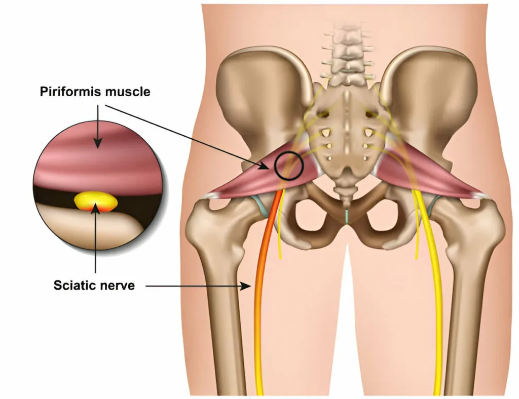 What is Sciatica? Causes, Treatments, and Pain Relief Tips 3 GetPaidStock.com 67dbe5df0d737 What is Sciatica? Causes, Treatments, and Pain Relief Tips