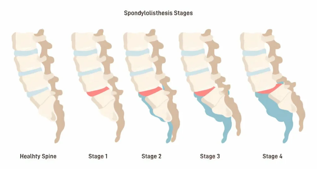 What is Sciatica? Causes, Treatments, and Pain Relief Tips 4 GetPaidStock.com 67dbe676081d1 117545108d What is Sciatica? Causes, Treatments, and Pain Relief Tips