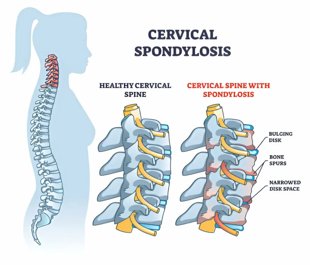 Understanding the Difference Between Spondylosis and Spondylitis 1 GetPaidStock.com 68089e4ec59f8 Understanding the Difference Between Spondylosis and Spondylitis