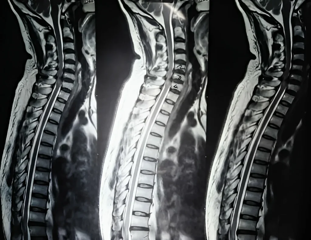 Understanding the Difference Between Spondylosis and Spondylitis 3 GetPaidStock.com 6808a13d51c49 Understanding the Difference Between Spondylosis and Spondylitis