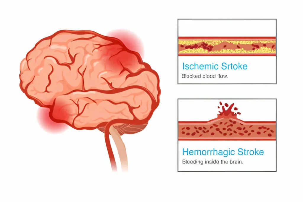 Brain Stroke Recovery Time: How Long Does It Take? 1 GetPaidStock.com 6810e2dd0b784 Brain Stroke Recovery Time: How Long Does It Take?